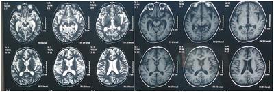 Case report: Tongdu Xingshen acupuncture for a patient with persistent vegetative state after herpes simplex virus encephalitis